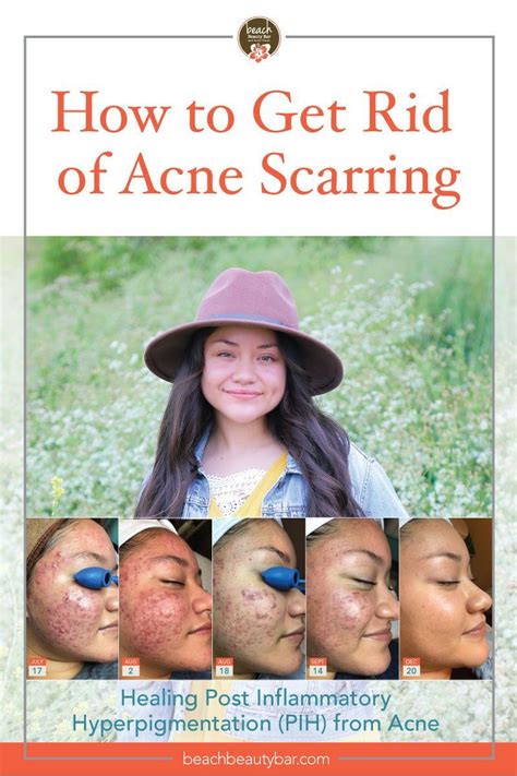 Healing Acne Scars And Post Inflammatory Hyperpigmentation Can Be