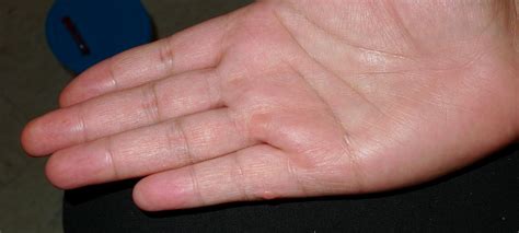 Simple Extra Digits Congenital Hand And Arm Differences