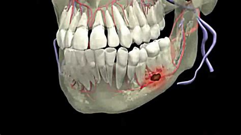 علاج خراج الاسنان الداخلي