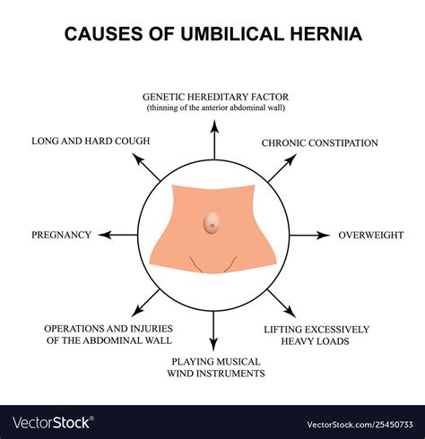 Causes Umbilical Hernia Infographics Royalty Free Vector