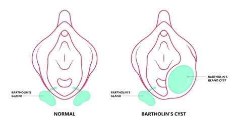 Bartholin Cyst Treatment Best 17 Homeopathic Medicines