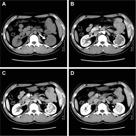 Unenhanced Axial Ct And Contrast Enhanced Ct Scans A Unenhanced