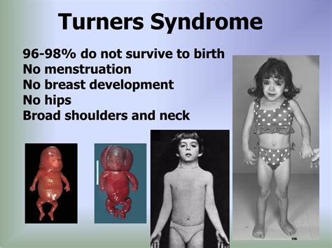 What Do You Know About Turner Syndrome Vrogue Co