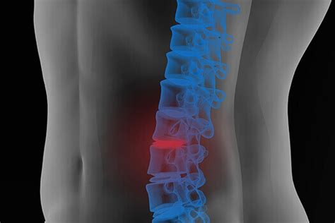 Lumbar Spine Cysts Causes And Treatments