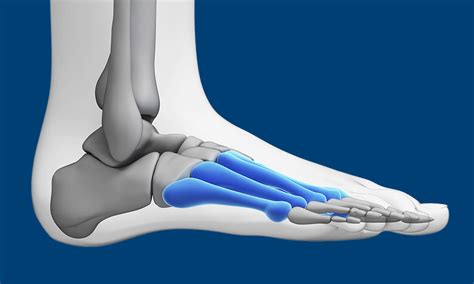 1st Metatarsal Pain Top Of Foot Radiographic Views And Associated