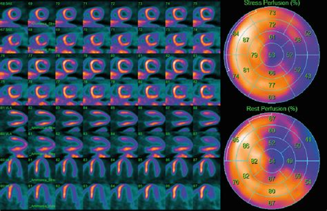 Pet Myocardial Perfusion Imaging In The Assessment Of Coronary Artery