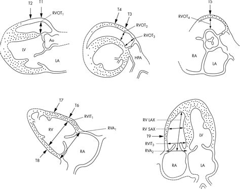 Anatomy Echocardiography And Normal Right Ventricular Dimensions Heart