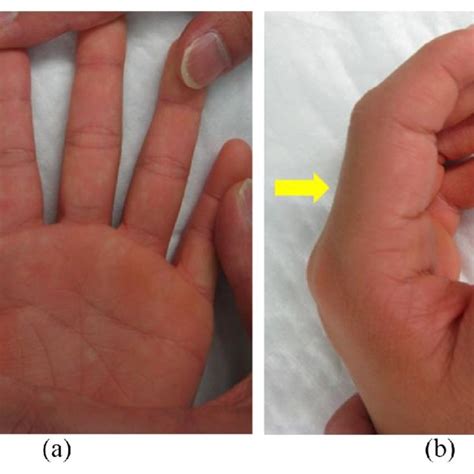 The Left Index Finger A B Showed Diffuse Soft Tissue Swelling