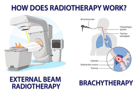 The Site For Healthcare Professionals Radiotherapy