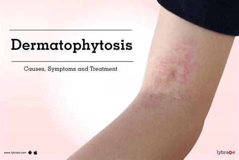 Dermatophytosis Causes Symptoms And Treatment By Dr Anshu Aggarwal
