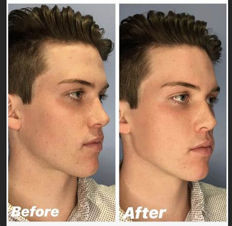 Jaw Filler Before And After Male