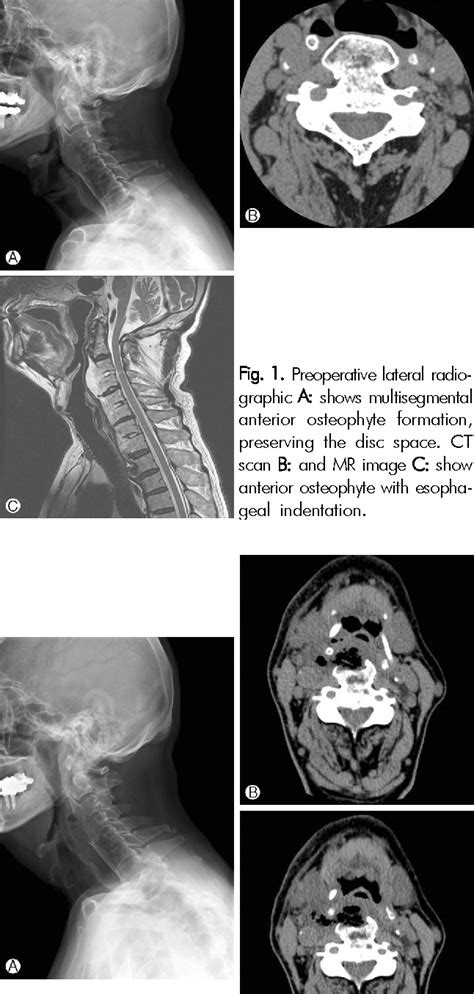 Figure 1 From Gelfoam Induced Swallowing Difficulty After Anterior
