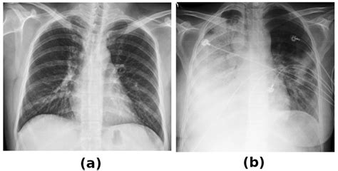 Lung Cancer Vs Normal Chest X Ray