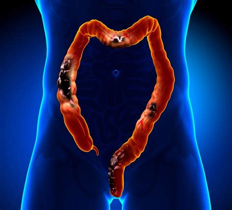 Signs Of Colon Cancer In Women And Early Prevention