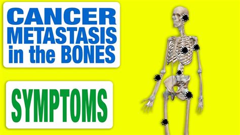 Cancer Metastasis In The Bones All Symptoms Youtube