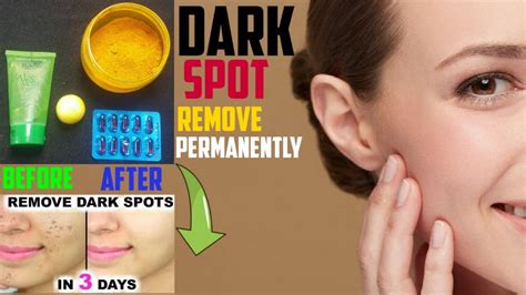 How To Remove Dark Spots From Face Simple Home Remedy By Food Feast
