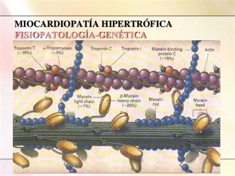 ¿qué es la miocardiopatía hipertrófica? Miocardiopatia hipertrofica