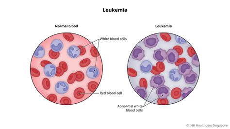 Leukemia Blood Cancer Symptoms And Causes Gleneagles Hospital