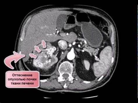 Какая диета при удаление почки