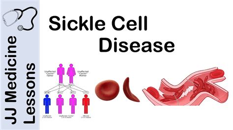 Sickle Cell Syndrome Sickle Cell Disease All You Need To Know