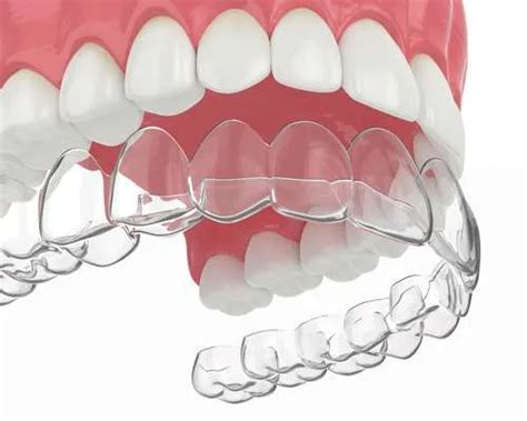 Invisible Braces Invisalign® In Carmichael Ca Marconi Dental Group