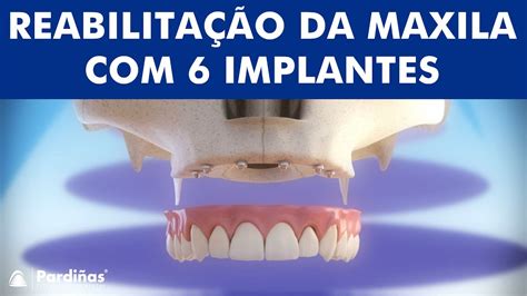 Exercícios Para O Maxilar