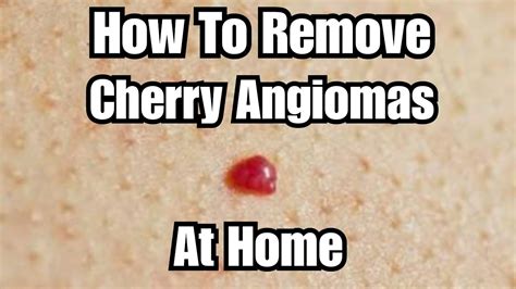 Cherry Angioma On Face Removal At Home How To Get Rid Of Cherry