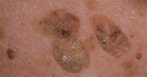 Seborrheic Keratosis Which Occurs In Sun Exposed Skin The Same Kind Of