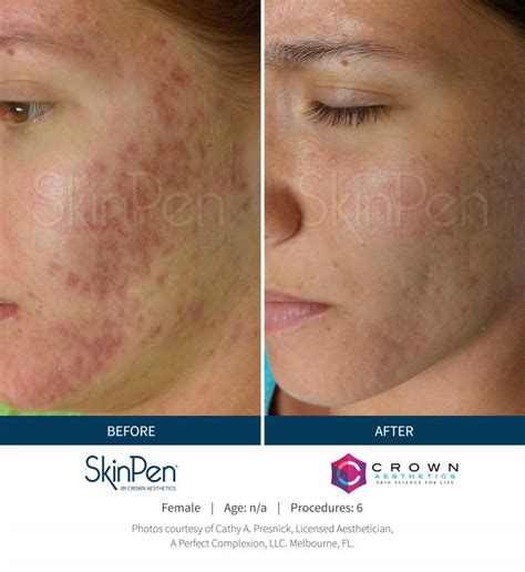 Skinpen Before And After Skinpen Microneedling Crown Aesthetics