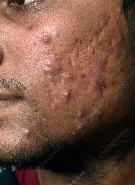 Cystic Lesions In Acne Stock Image C0372215 Science Photo Library