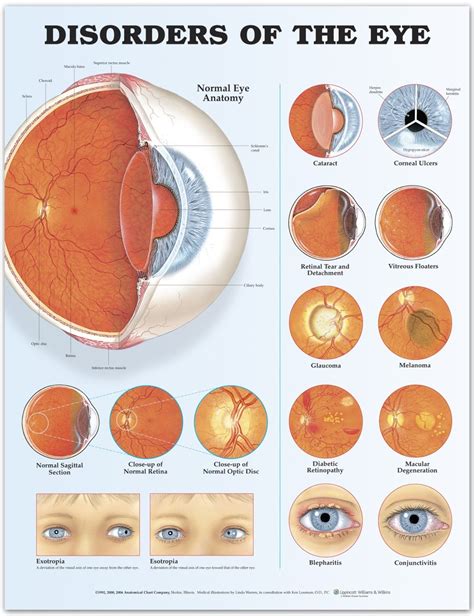 Disorders Of The Eye Poster Eye Disease Anatomical Chart Company