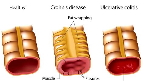 What Is The Difference Between Colitis And Ulcerative Colitis Ulcer