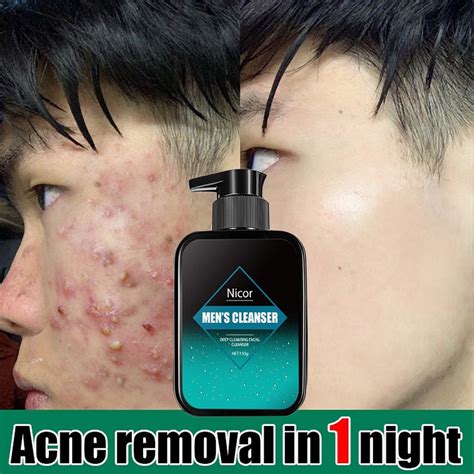 Jerawat Facial Mites Acne Cleanser Sabun Jerawat Muka Sabun Muka Pencuci Lelaki To Oil Control