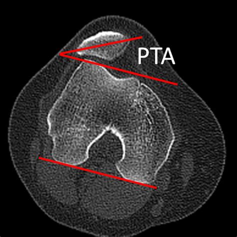 The Measurement Of The Patellar Tilt Angle Pta Defined As The Angle
