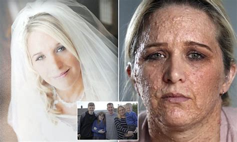 Huddersfield Woman With Nf1 Scared To Leave House Daily Mail Online