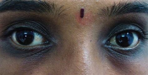 Removal Of Dark Spots Under Eyes Creams Skincarederm