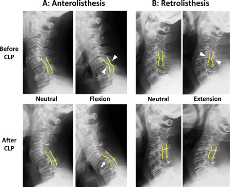 Segmental Cervical Instability Does Not Drive The Loss Of Cervical