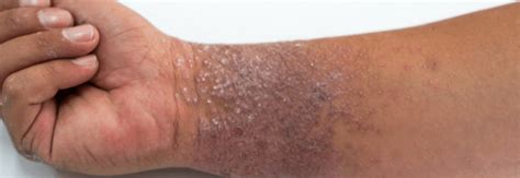 How To Get Rid Of Eczema On Wrist The Eczema Company Blog Blog