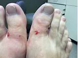 Images of Recovery Time From Ingrown Toenail Removal