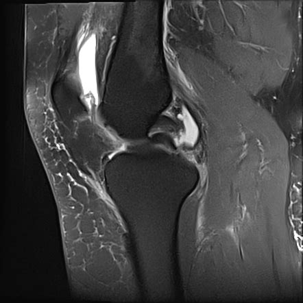 Combined Medial And Lateral Bucket Handle Meniscal Tears Radiology My
