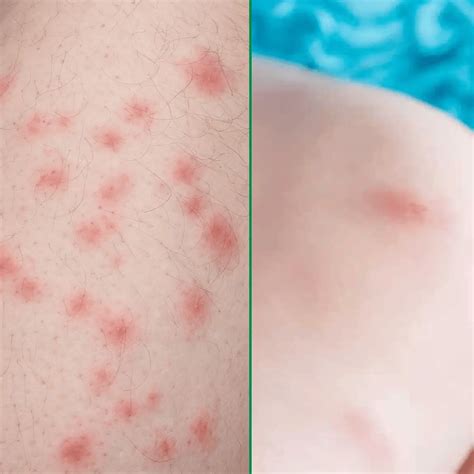 Bed Bug Bites Vs Hives Bed Bugs Sprays