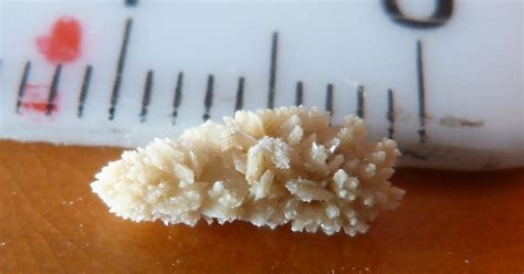 Composition of stones vs shapes/size chart. How To Prevent Kidney Stones In 6 Simple Steps - David ...