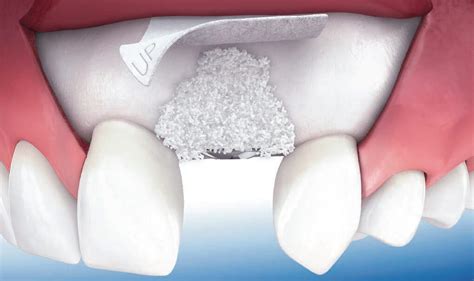 Bone Graft And Membrane Procedure At America Dental Clinic