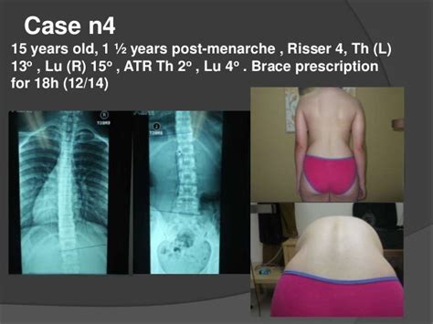 Brace Treatment For Adolescent Idiopathic Scoliosis Ais And Scheuer
