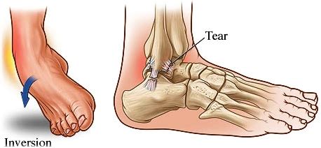 LATERAL ANKLE LIGAMENT SPRAIN - Core Healthcare