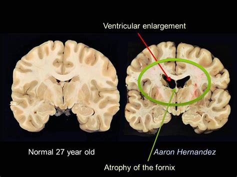 A putative biomarker for cte is the presence in serum of autoantibodies against the brain. Photos of Aaron Hernandez's Brain Showing Significant CTE ...