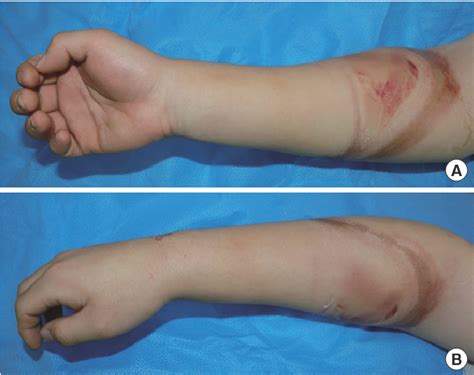 Figure 1 From Atypical Signs Of Compartment Syndrome Caused By Pressure