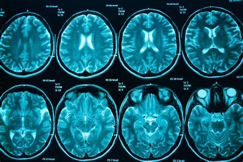 Are There Early Indicators Of Cte In The Brains Of Epilepsy Patients