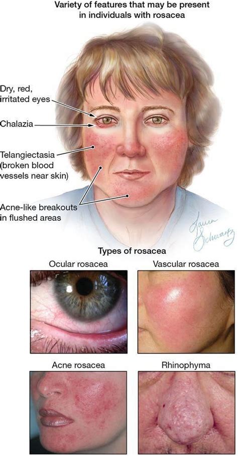Penicillin g in acrodermatitis atrophicans and cold urticaria; #PoppingPimples | Rosacea treatment, Rosacea symptoms ...