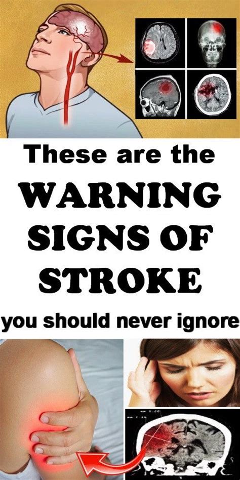 Warning Signs Of A Stroke You Should Never Ignore Severe Headache